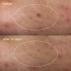 Dermalogica Deep Breakout Liquid Patch 21 Dermalogica Deep Breakout Liquid Patch -Care Product Shop dermalogica deep acne liquid patches 1