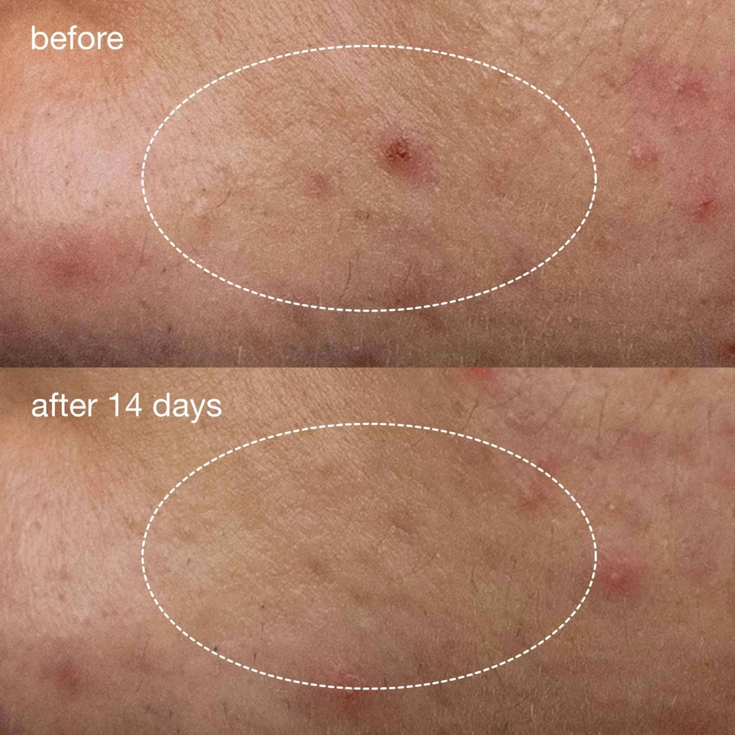 Dermalogica Deep Breakout Liquid Patch 10 Dermalogica Deep Breakout Liquid Patch - Image 8